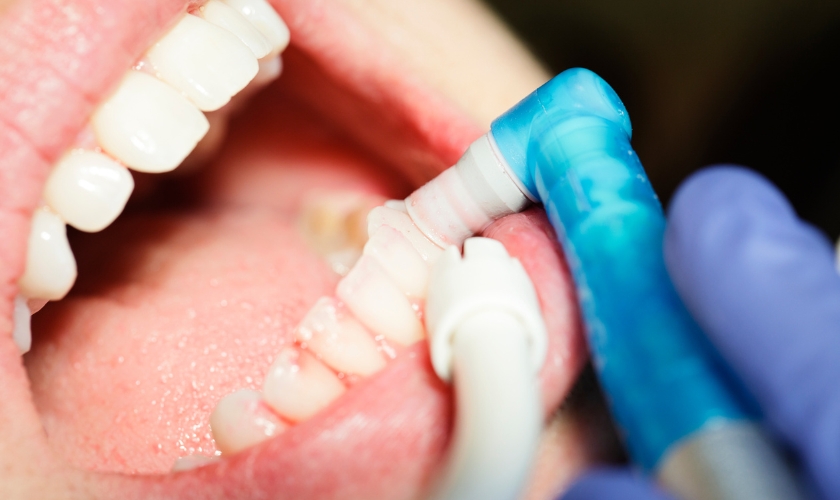 dental cleaning
