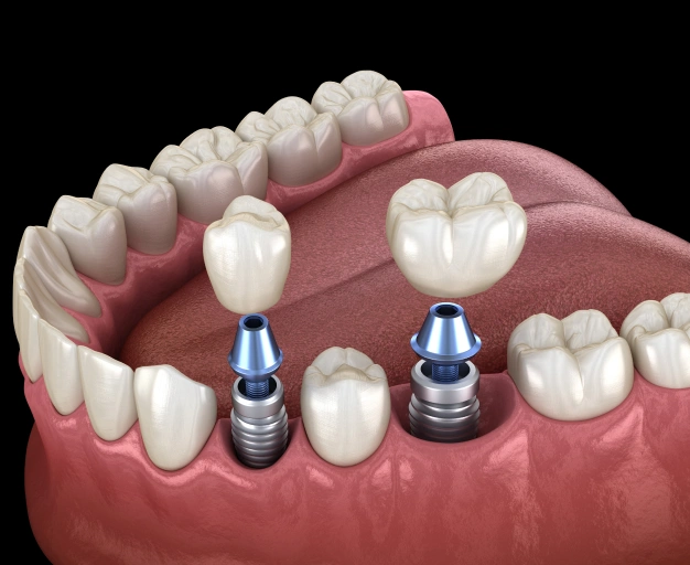 Dental Implant Restoration in Plant City, FL - Horizon Dental Designs