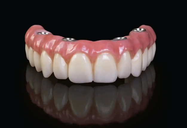 Implant-Supported Dentures in Plant City, FL - Horizon Dental Designs