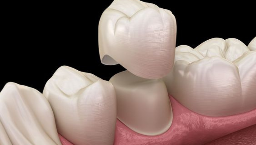 Featured image for “From Start to Smile: A Patient-Friendly Same-Day Crown Guide for Busy Lives”