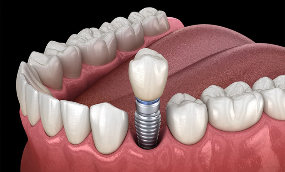 speed up dental implant healing