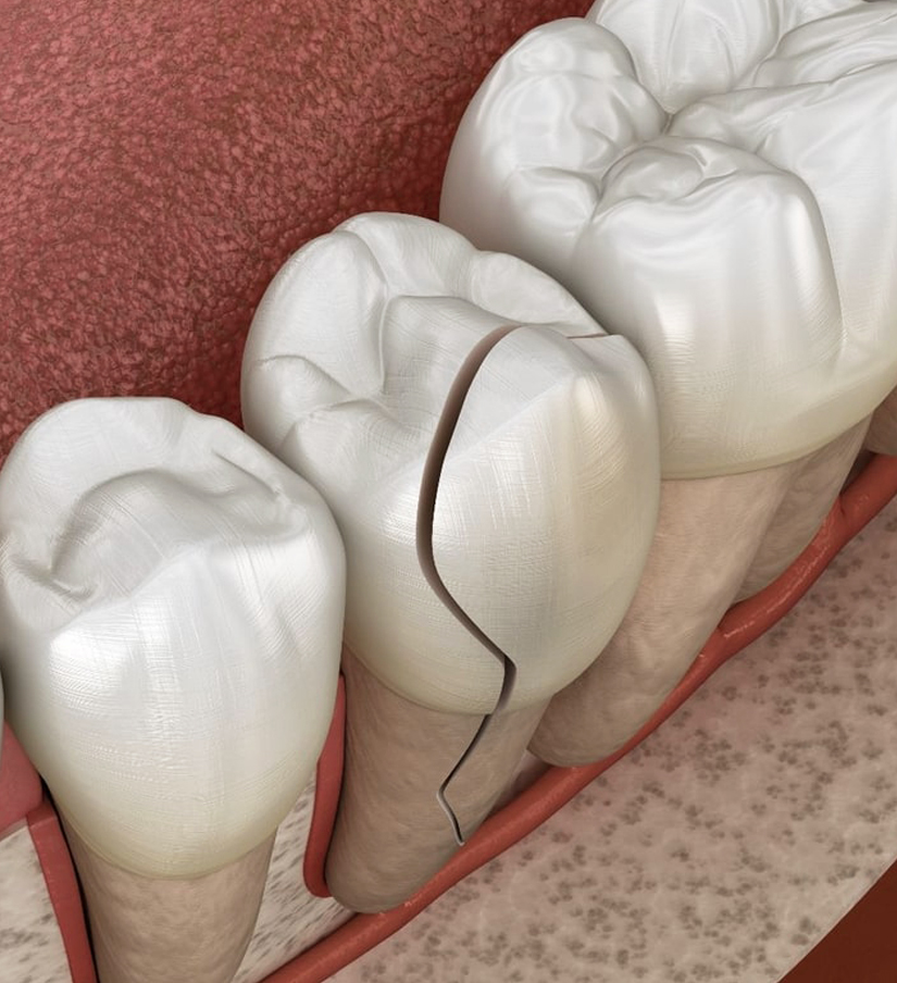 Chipped Tooth Repair in Kyle, TX