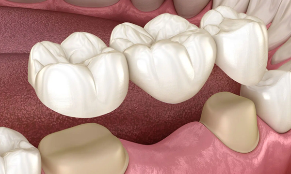 Dental Bridges in Kyle, TX