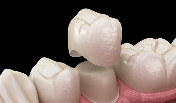 Dental Crowns in Kyle, TX