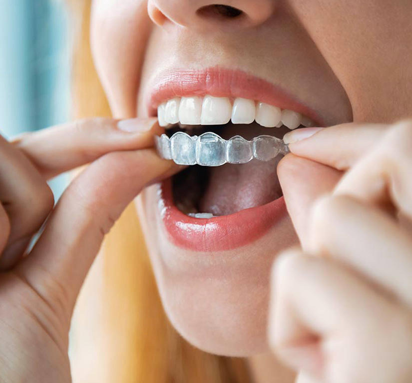 Invisalign in Kyle, TX