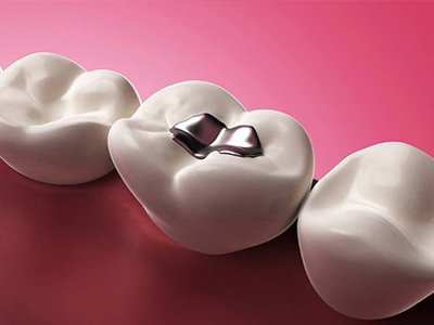 Tooth-Colored Fillings - Cosmetic Dentist in Kyle, TX