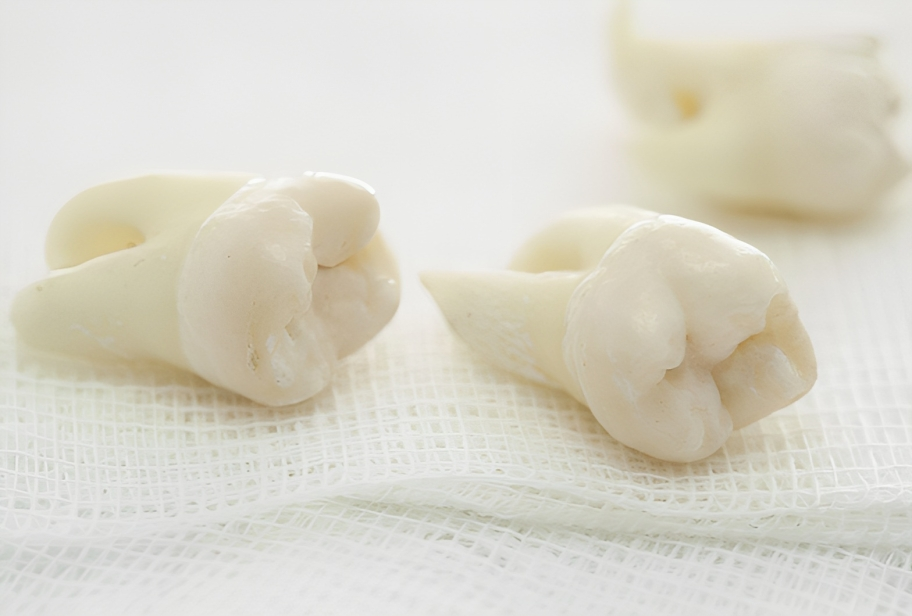 Tooth Extractions in Kyle, TX