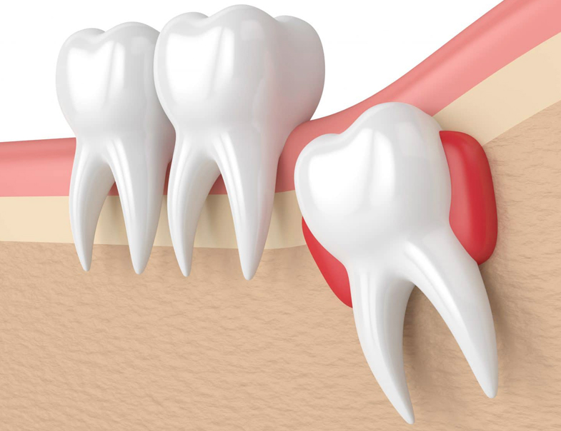 Wisdom Teeth Removal in Kyle, TX