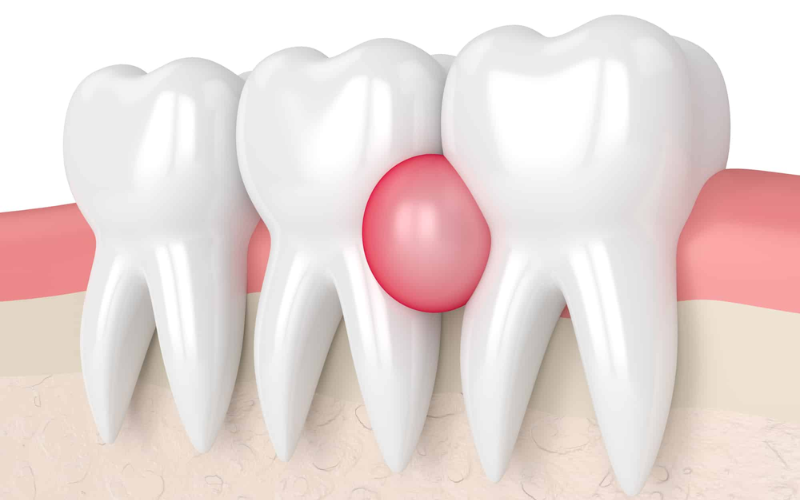Why Ignoring Dental Abscess Can Lead To Serious Emergency