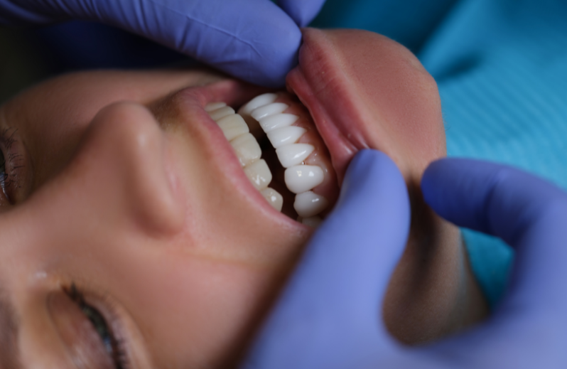 Five Key Features That Make Porcelain Veneers A Top Cosmetic Dentistry Choice