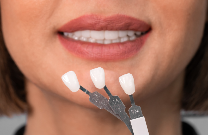 Before You Get Veneers 5 Essential Questions Answered