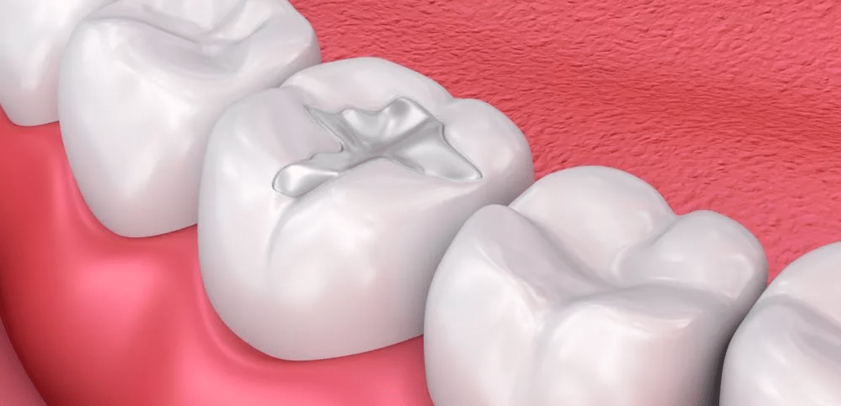 Why Composite Fillings are Ideal for Treating Decayed Teeth