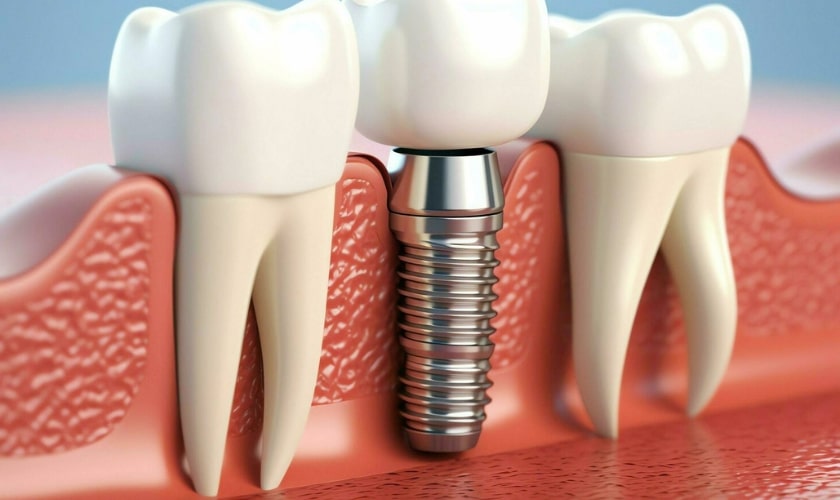 can gum disease stop you from getting dental implants