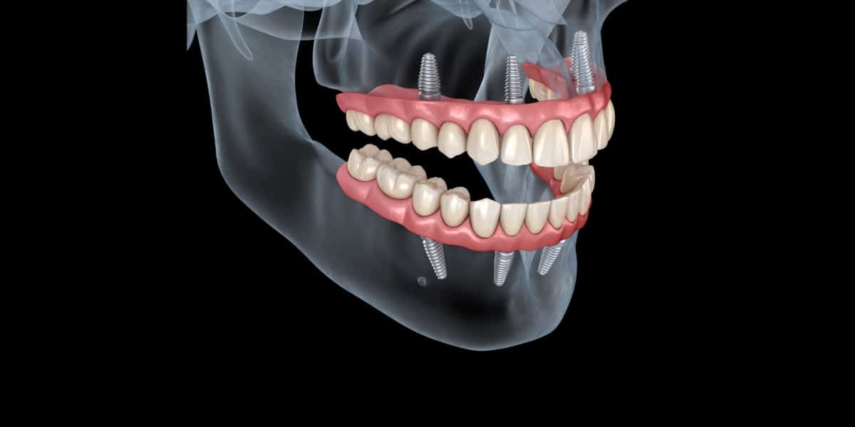 all-on-x implants