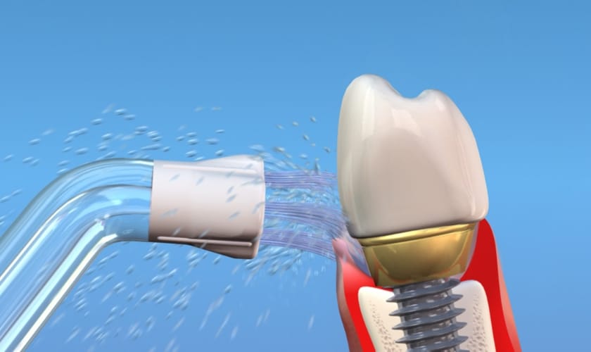 Essential Tips for Keeping Dental Implants Clean