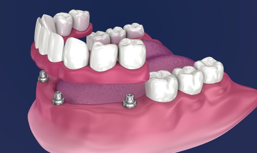 eligiblility criteria for get full mouth dental implants