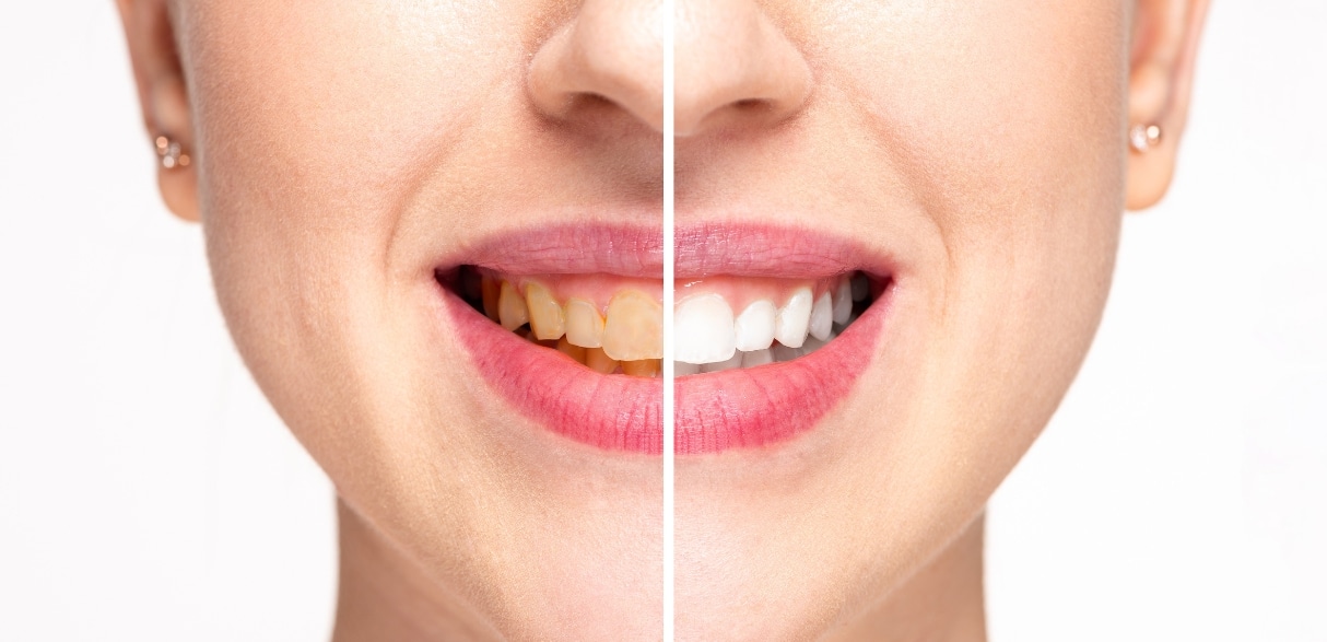 why professional teeth whitening wins over diy