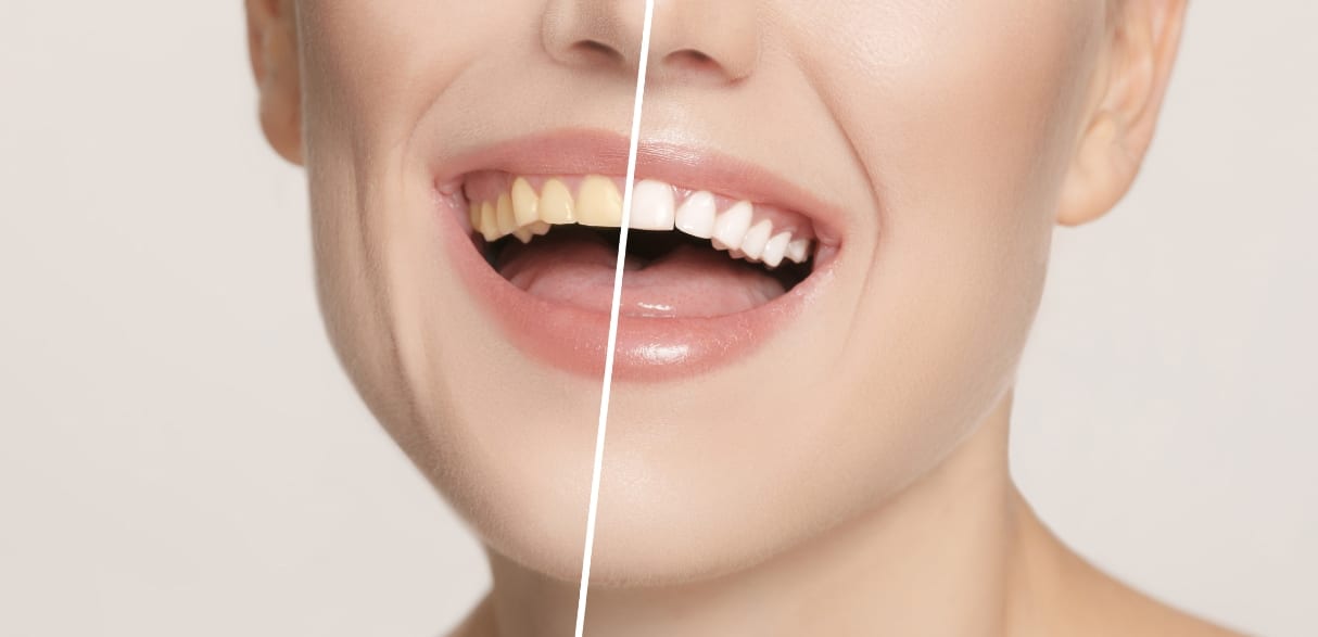 what not to eat after professional teeth whitening