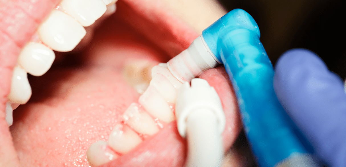 Why Regular Dental Cleanings Outperform Intensive Brushing?