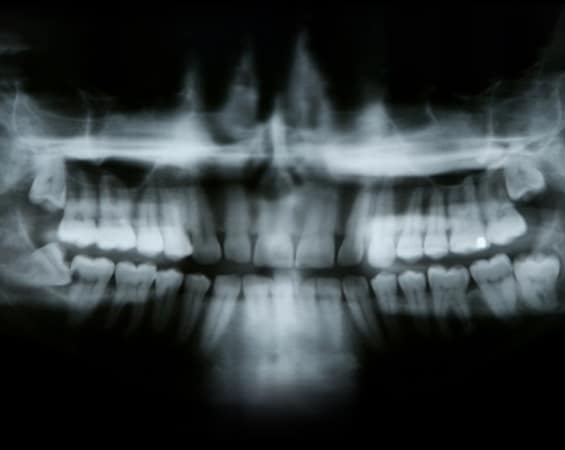 After Impacted Tooth Removal - Post-op Instructions - North Dover Dental