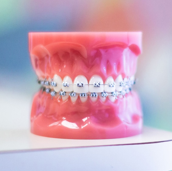 Braces in Toms River, NJ - North Dover Dental