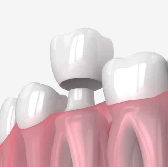 Crowns in Toms River, NJ - North Dover Dental