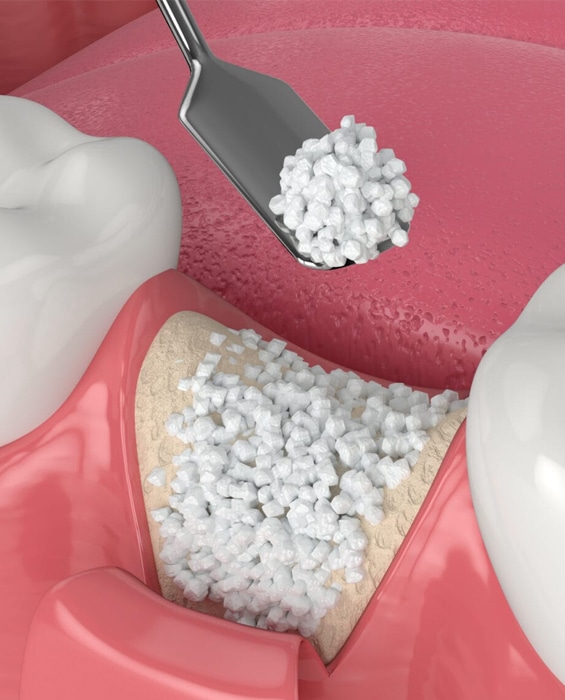 Extraction Site Preservation in Toms River, NJ - North Dover Dental