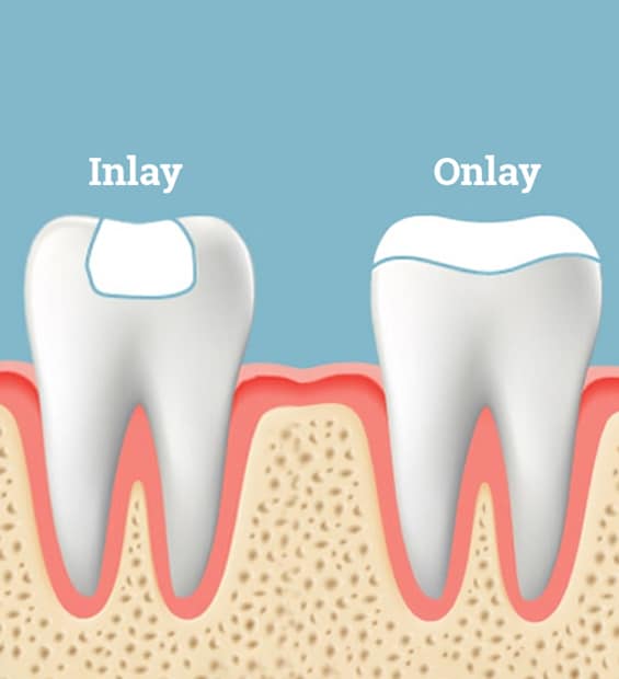 Inlays and Onlays in Toms River, NJ - North Dover Dental