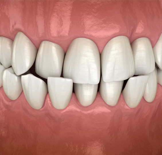 Occlusal Adjustment in Toms River, NJ - North Dover Dental