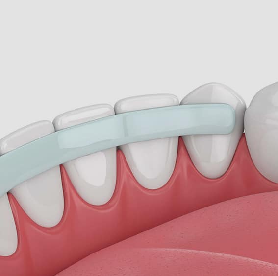 Periodontic Splinting in Toms River, NJ - North Dover Dental