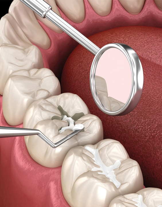Dental Sealants in Toms River, NJ - North Dover Dental