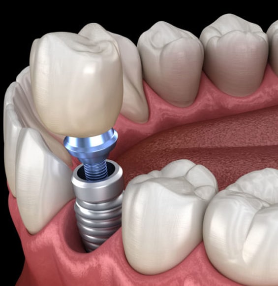Simplant in Toms River, NJ - North Dover Dental
