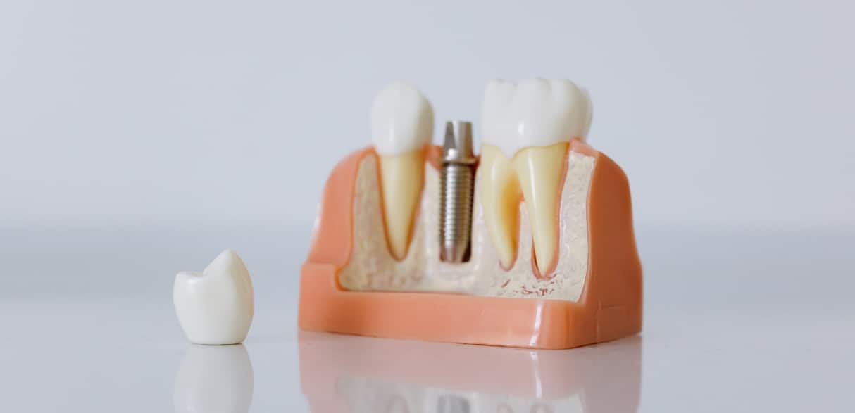 factors to consider when seniors get dental implants