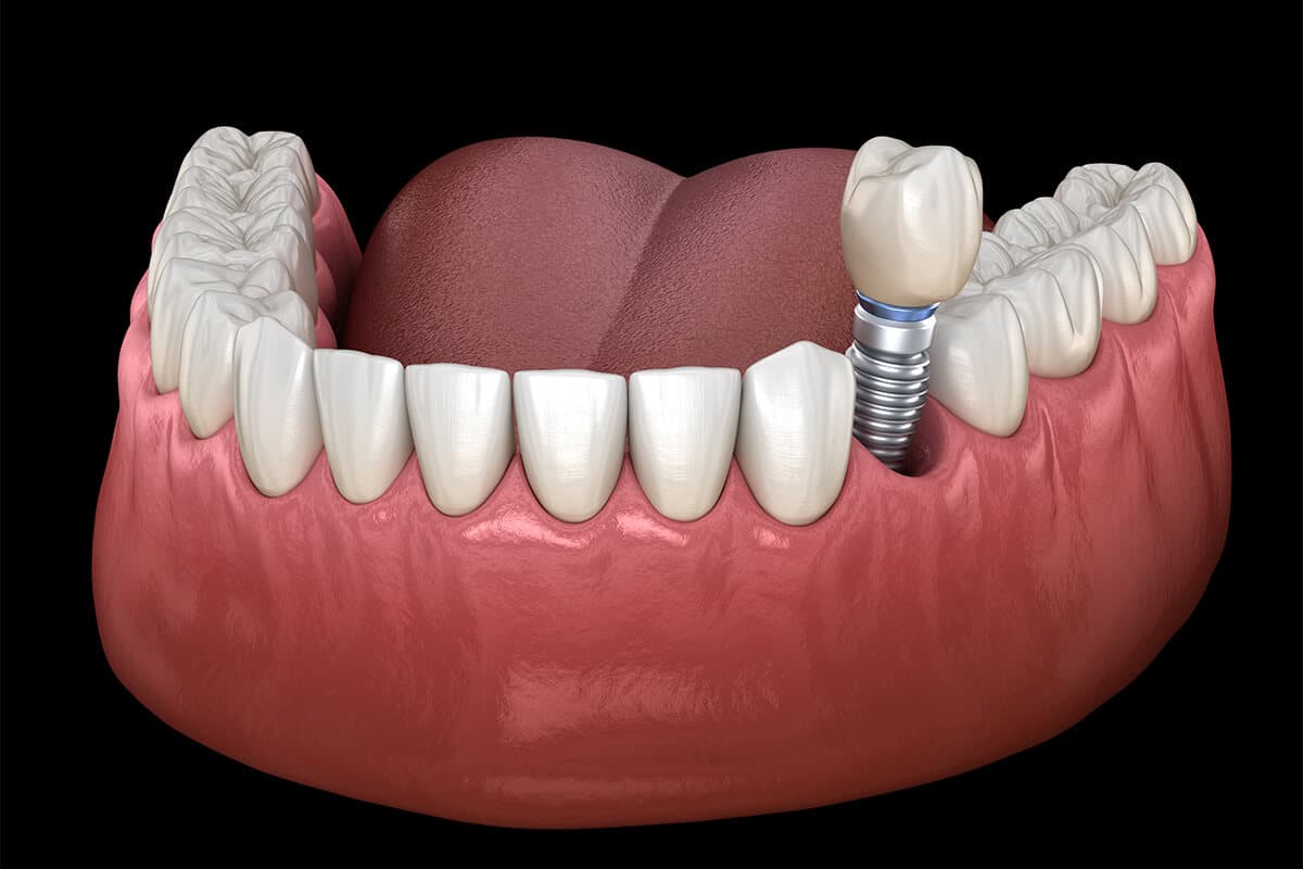 can dental implants restore your entire smile find out how