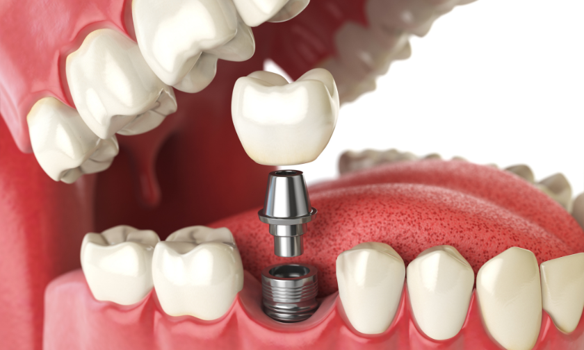 Dental Implants for Diabetic Patients: What to Consider Before Treatment