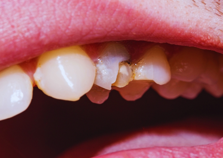 how to fix Chipped Tooth?
