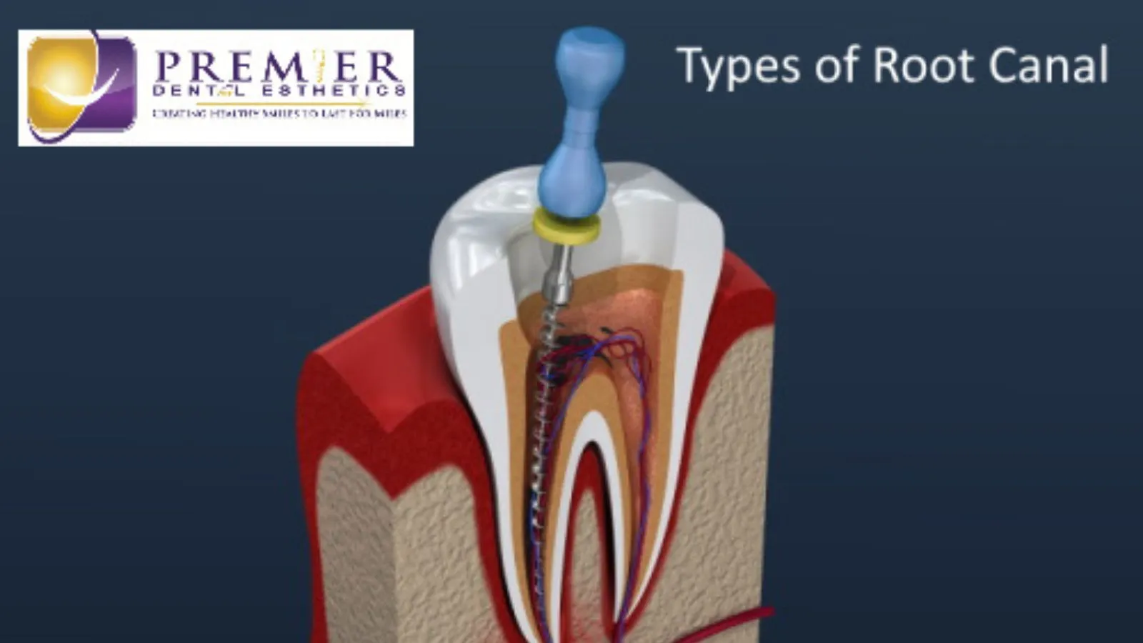 Types of Root Canal