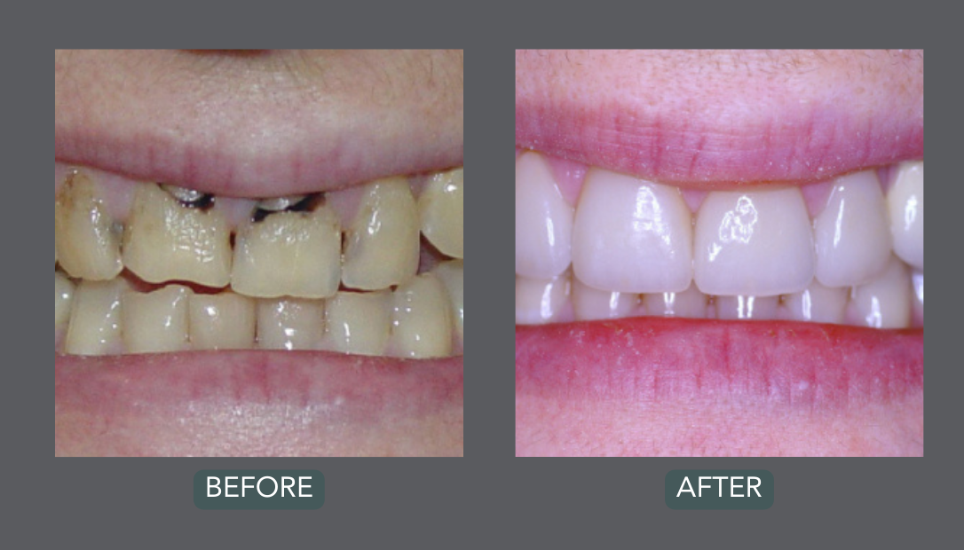 maintain your results after cosmetic dental procedures