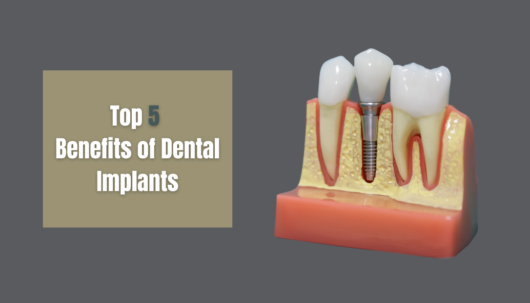 top 5 benefits of dental implants you need to know