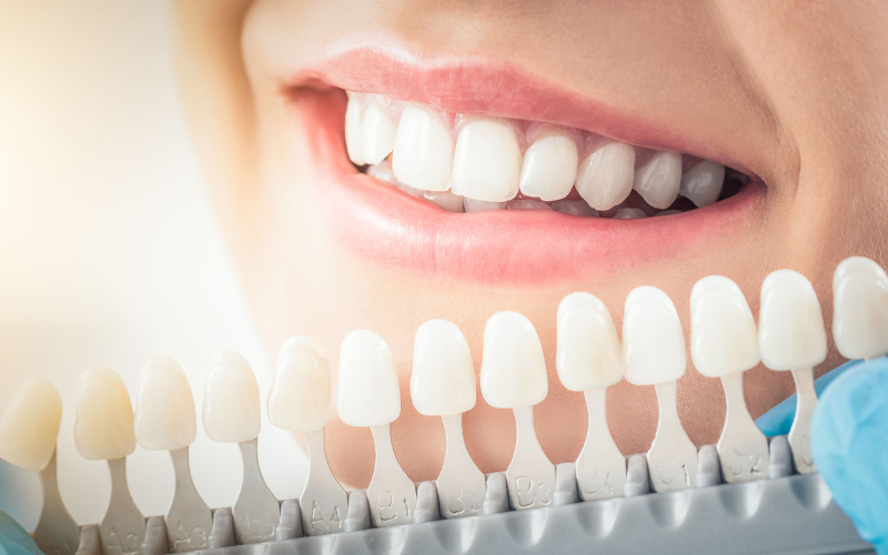 Veneers for Valentine Glow