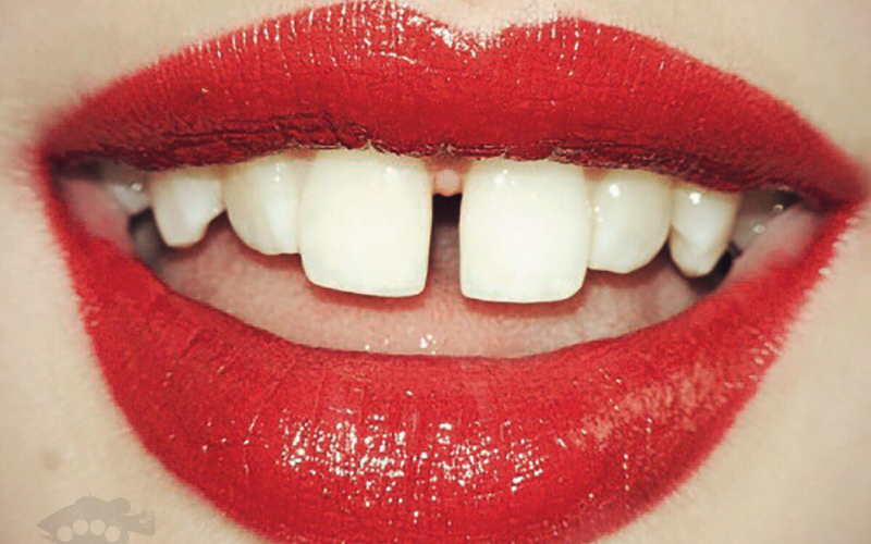 main cause of gapped teeth