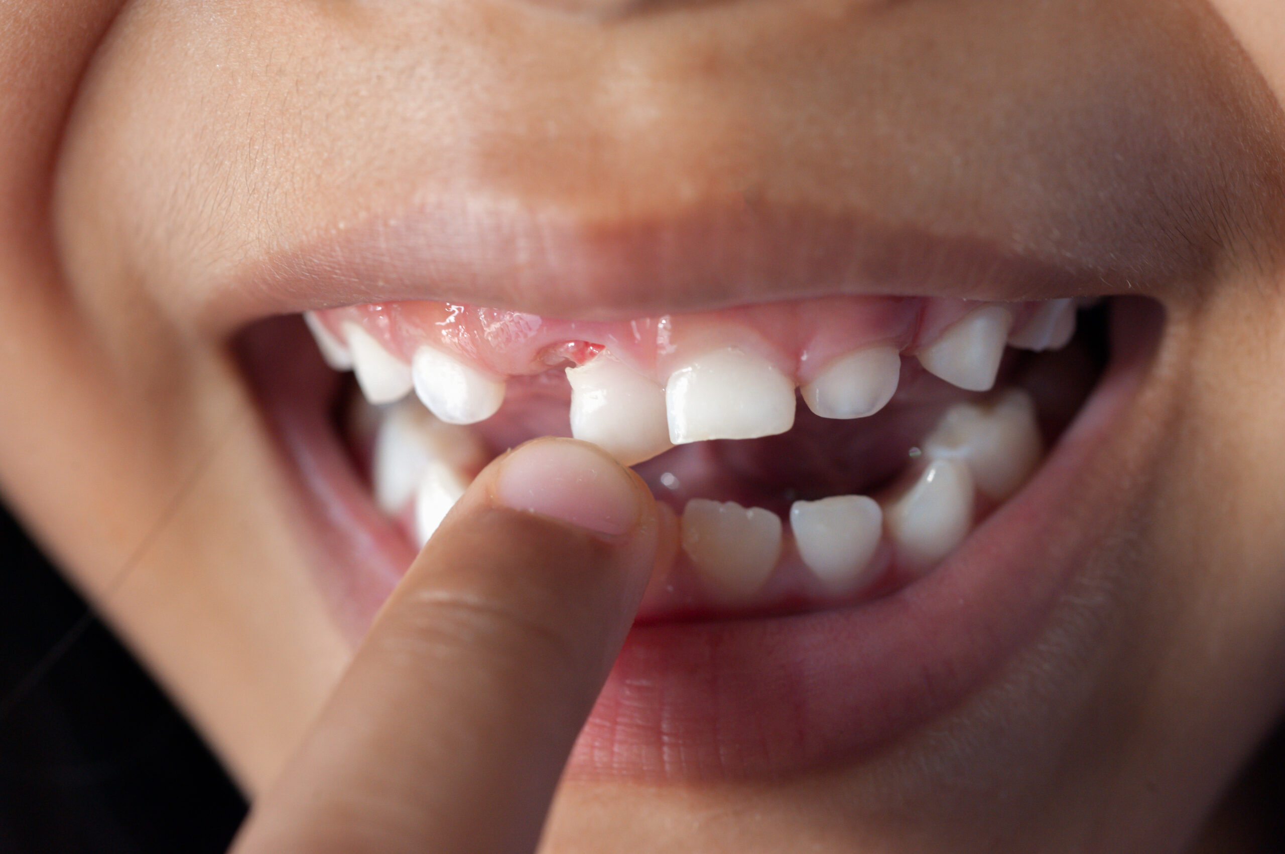 how to fix a loose tooth