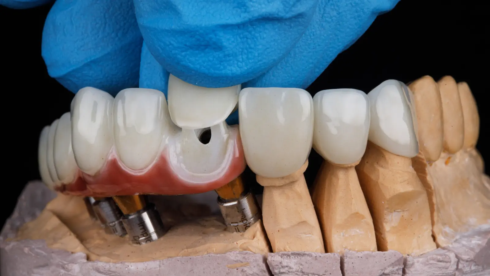 Different Types Of Dental Crowns Pros And Cons