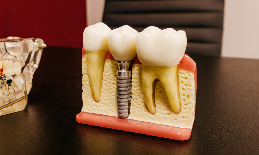 Can Smokers Get Dental Implants? What You Should Know