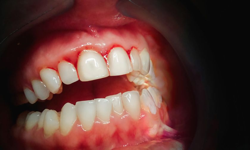 Can Periodontal Treatments Heal Gum Infections?